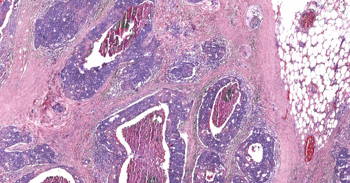 Pathology News Roundup: September 8, 2020